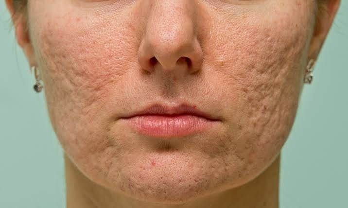 Acne Scar Treatment: MNRF, Subcision, Laser & Peels Compared