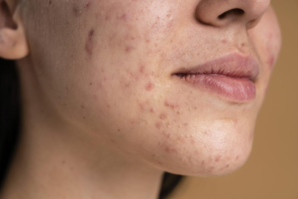 Acne-prone skin — acne treatment at Derma Wellness & Aesthetic Clinic, Ahmedabad