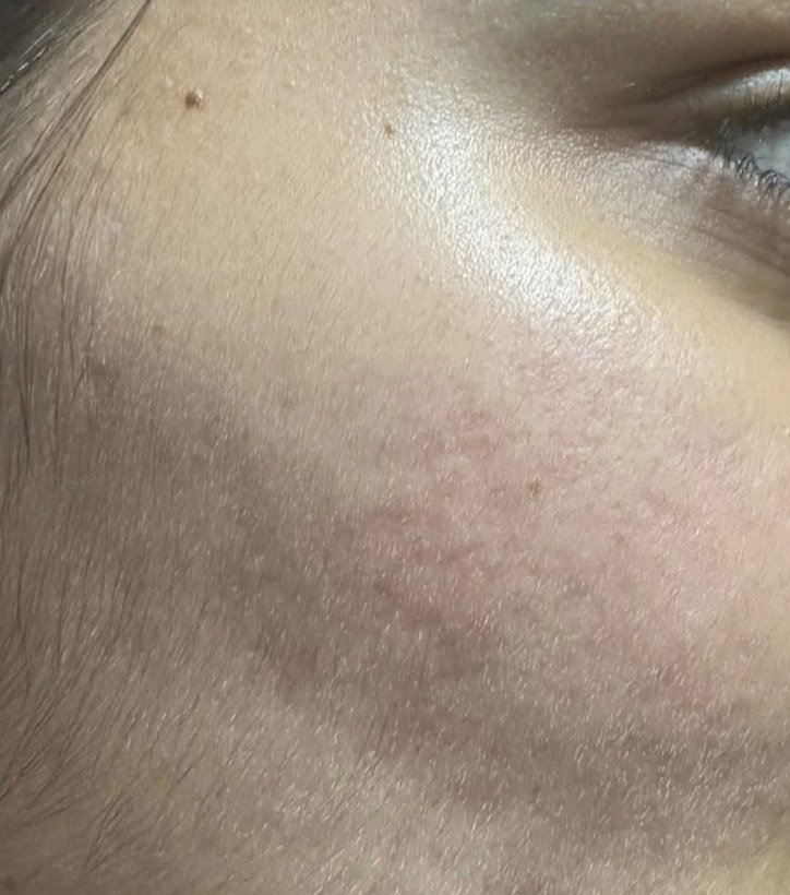 After — active acne treatment