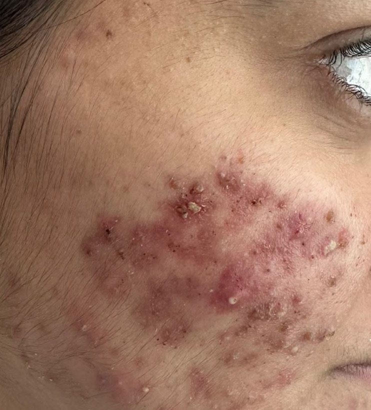 Before — active acne treatment