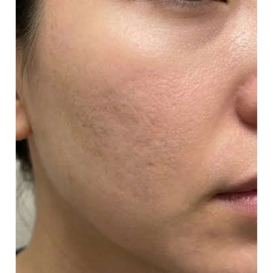 After — acne scar revision