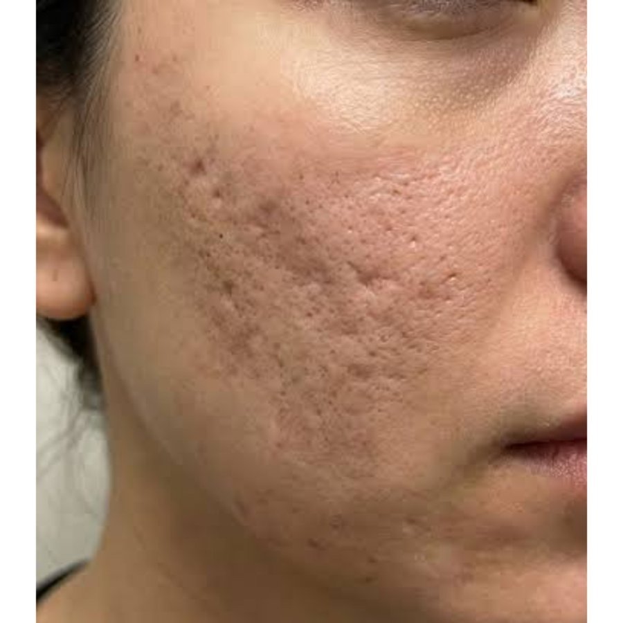 Before — acne scar revision