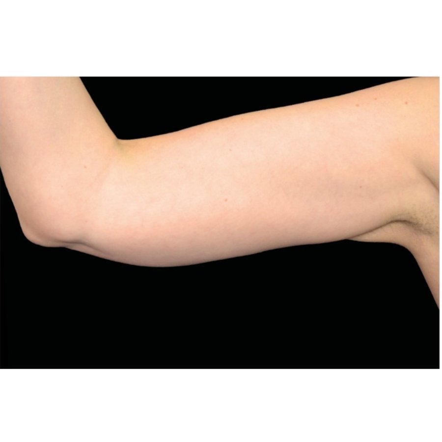 After — upper arm skin tightening