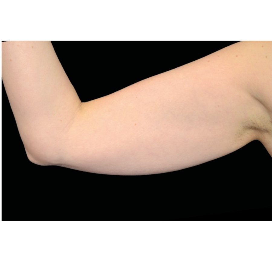 Before — upper arm skin tightening