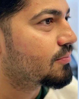 After — laser beard shaping, clean defined beard line