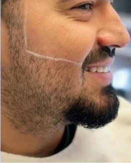 Before — laser beard shaping with marked cheek line