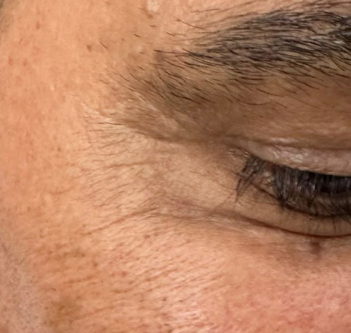 After — Botox for crow's feet