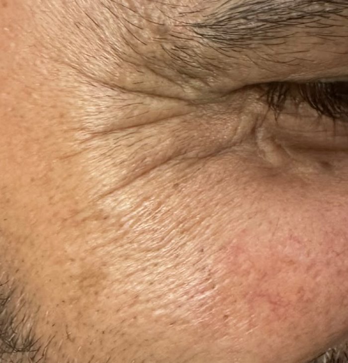 Before — Botox for crow's feet