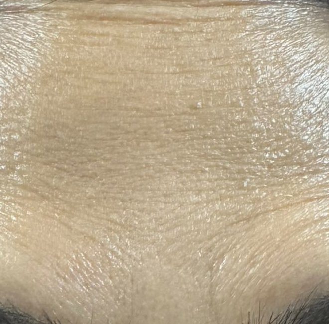 After — Botox for forehead lines
