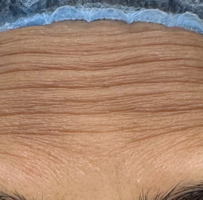 Before — Botox for forehead lines