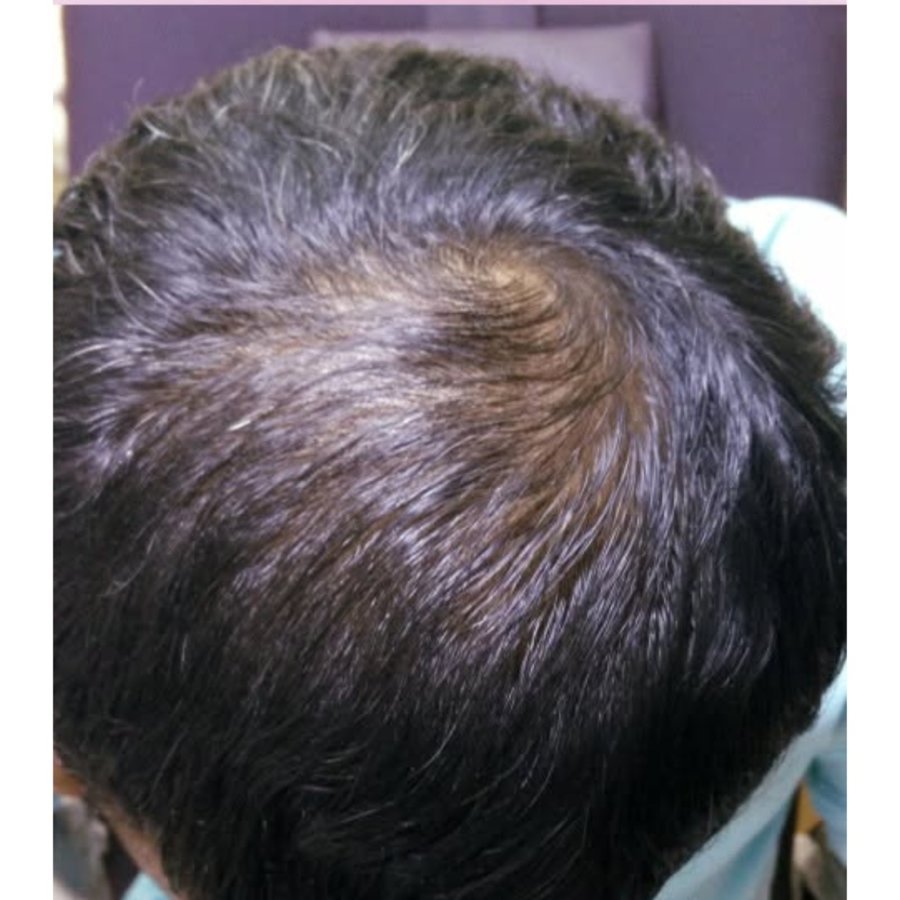 After — PRP hair regrowth