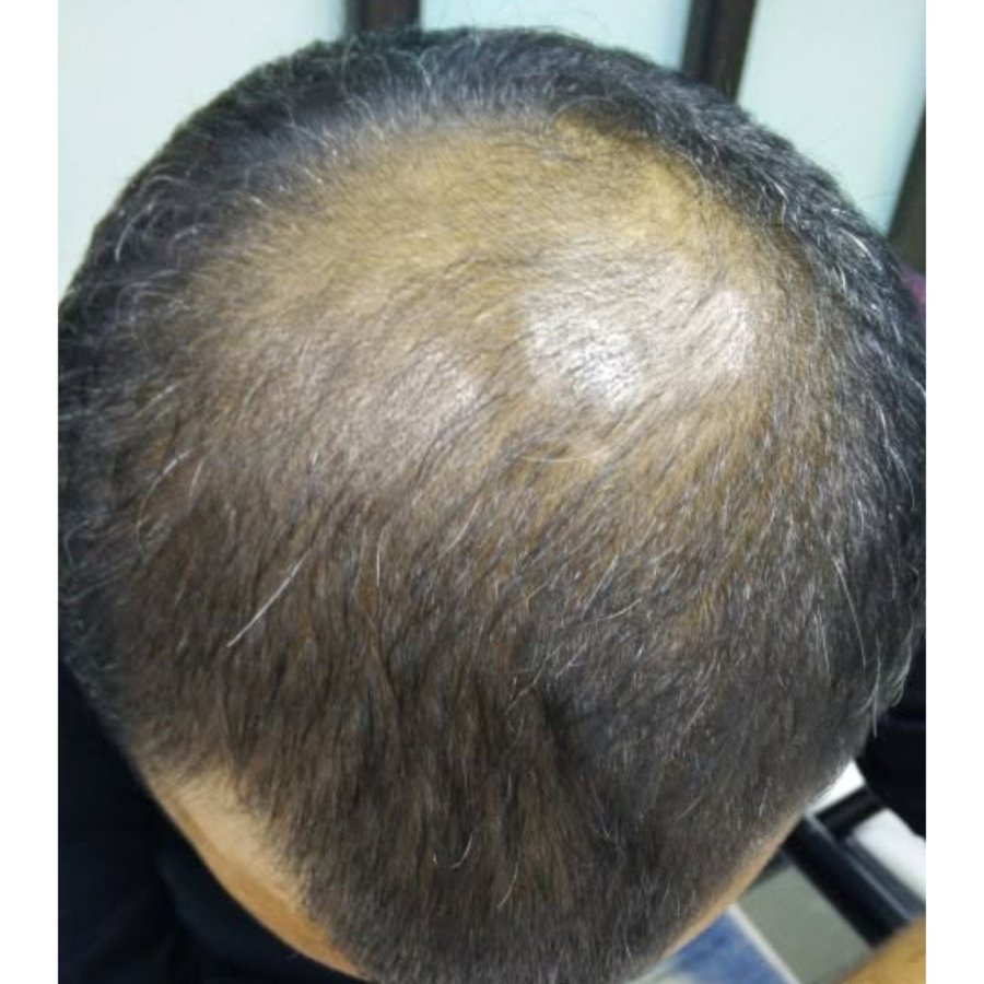Before — PRP hair regrowth
