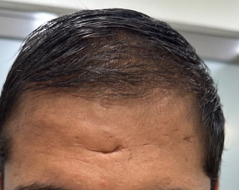 After — hair regrowth treatment