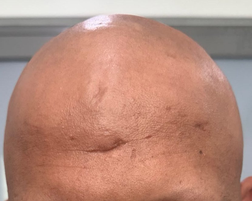 Before — hair regrowth treatment