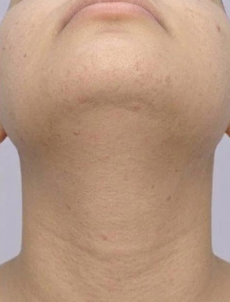 After — laser hair removal on chin and neck