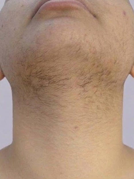 Before — laser hair removal on chin and neck