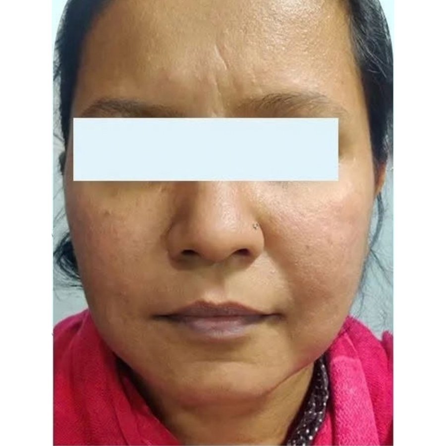 After — pigmentation treatment