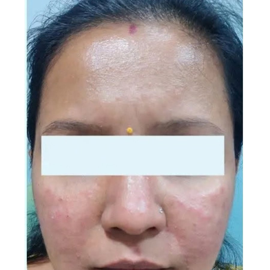 Before — pigmentation treatment