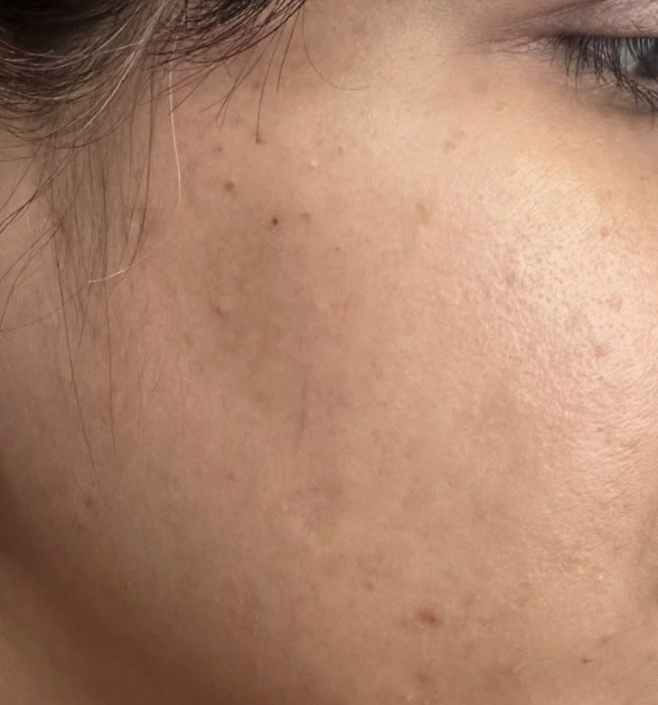 After — post-acne pigmentation treatment
