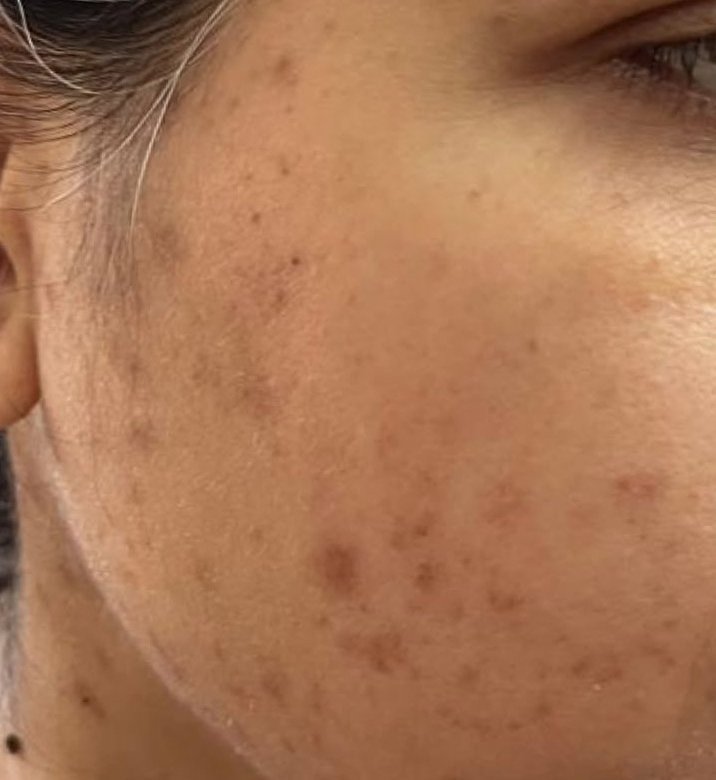 Before — post-acne pigmentation treatment