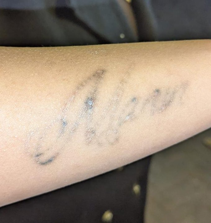After — laser tattoo removal
