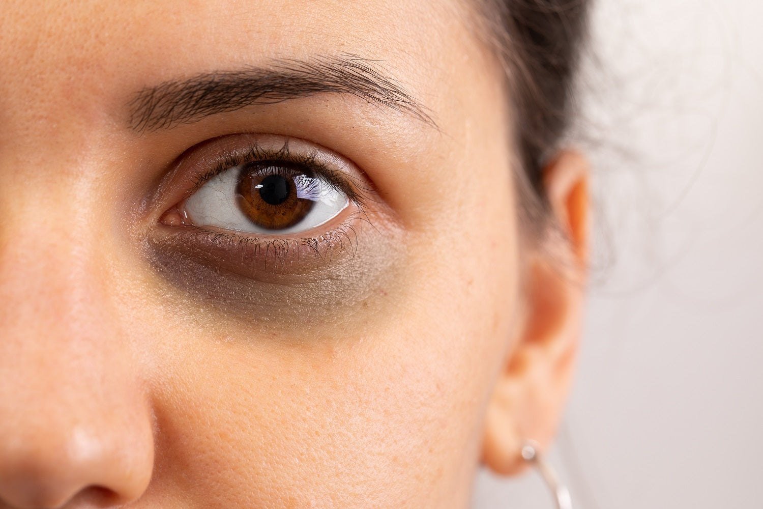 Dark Circles: Causes & Dermatologist Treatments That Actually Work