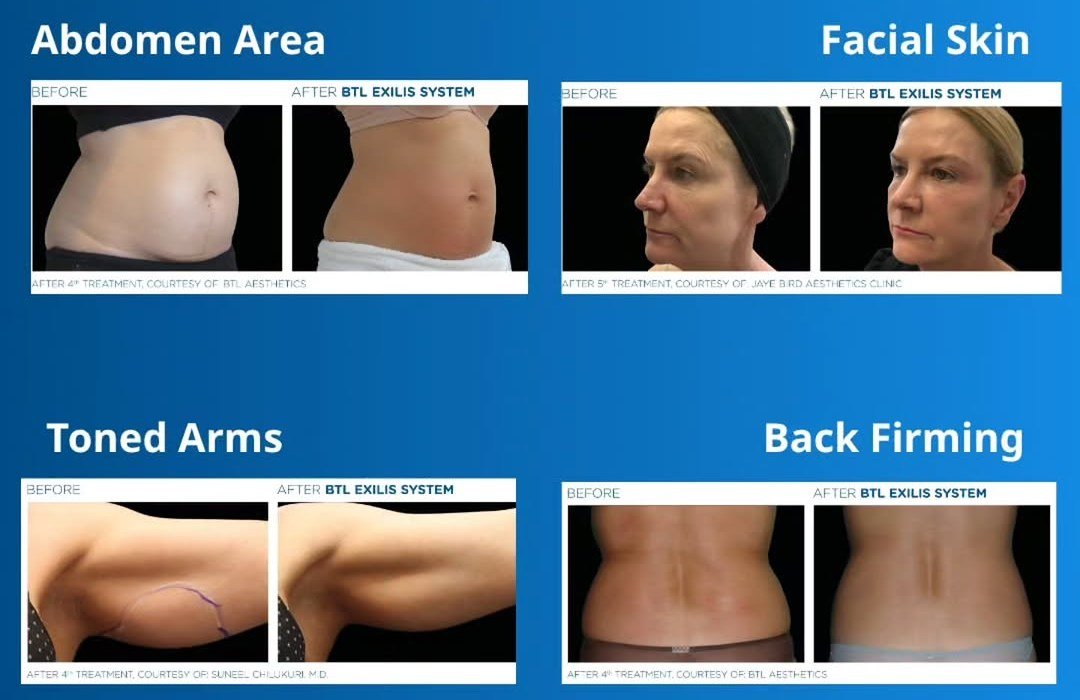 Exilis before and after skin tightening results on abdomen, face, arms and back