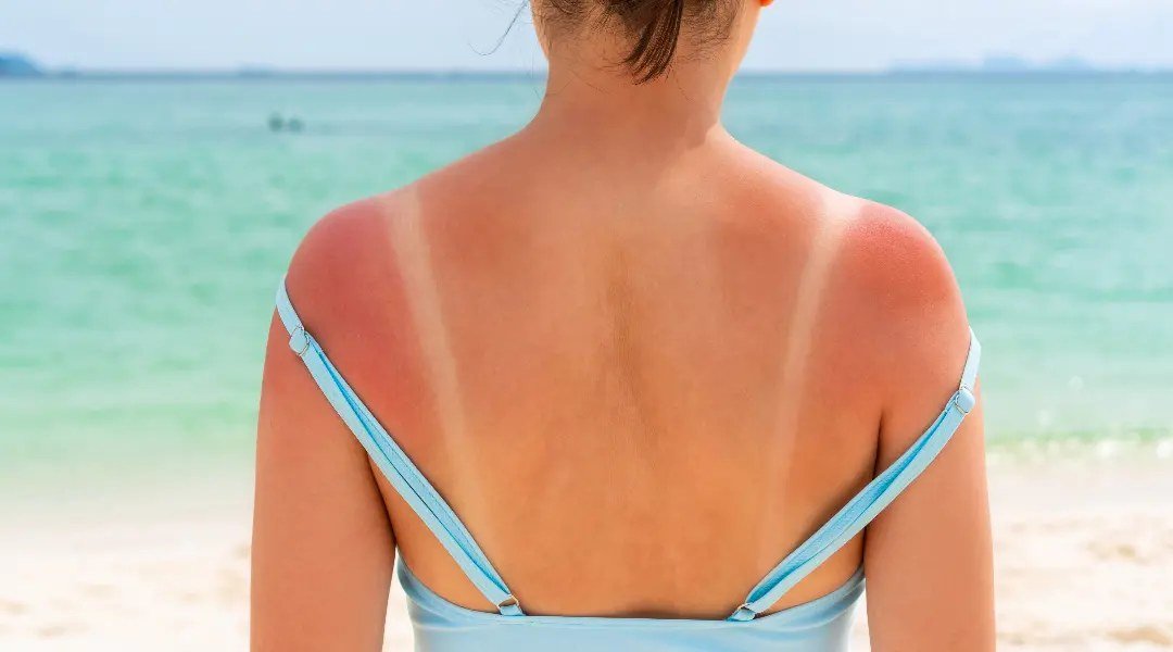 How to Remove Sun Tan: A Dermatologist’s Guide for Indian Skin